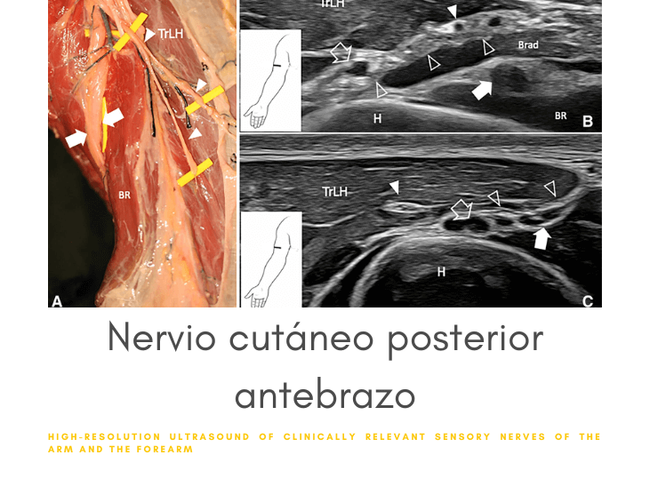 nervio-cutaneo-posterior-del-antebrazo-y-ecografia